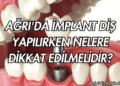 Ağrı'da İmplant Diş Yapılırken Nelere Dikkat Edilmelidir?
