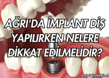 Ağrı'da İmplant Diş Yapılırken Nelere Dikkat Edilmelidir?
