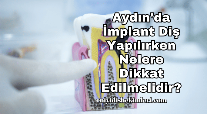 Aydın'da İmplant Diş Yapılırken Nelere Dikkat Edilmelidir?