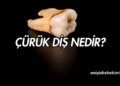 Çürük diş nedir?