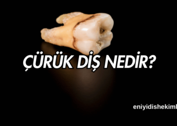 Çürük diş nedir?