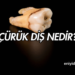 Çürük diş nedir?