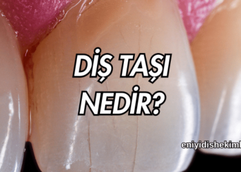 Diş Taşı Nedir?