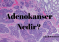 Adenokanser Nedir?