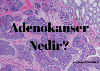 Adenokanser Nedir?