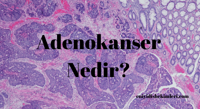 Adenokanser Nedir?