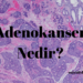 Adenokanser Nedir?