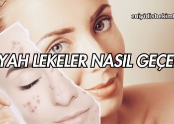 Siyah Lekeler Nasıl Geçer?
