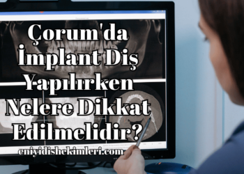 Çorum'da İmplant Diş Yapılırken Nelere Dikkat Edilmelidir?