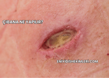 Çıbana Ne Yapılır?