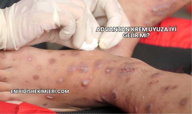 Advantan Krem Uyuza İyi Gelir mi?