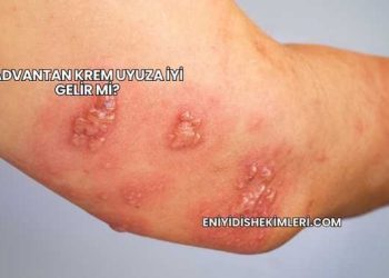 Advantan Krem Uyuza İyi Gelir mi?