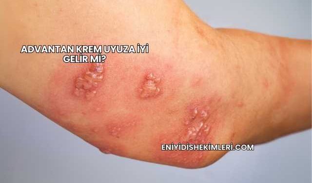 Advantan Krem Uyuza İyi Gelir mi?