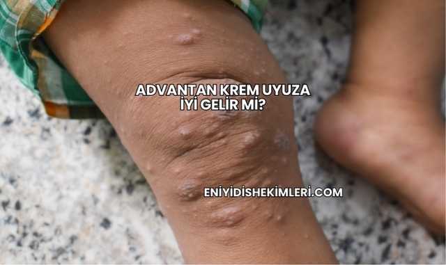 Advantan Krem Uyuza İyi Gelir mi?