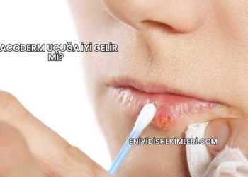 Bacoderm Uçuğa İyi Gelir mi?