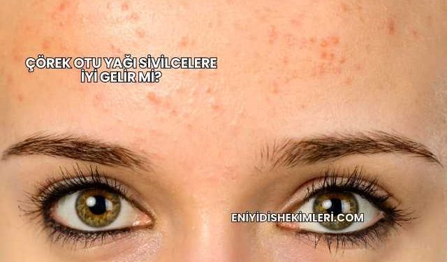 Çörek Otu Yağı Sivilcelere İyi Gelir mi?