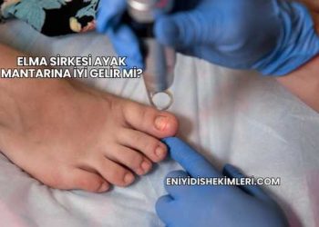 Elma Sirkesi Ayak Mantarına İyi Gelir mi?