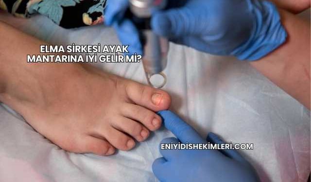 Elma Sirkesi Ayak Mantarına İyi Gelir mi?