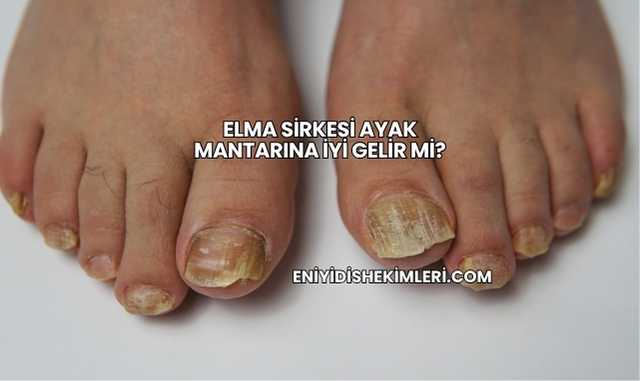 Elma Sirkesi Ayak Mantarına İyi Gelir mi?
