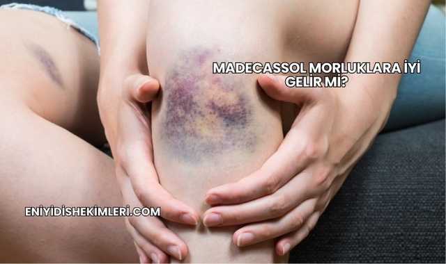 Madecassol Morluklara İyi Gelir mi?