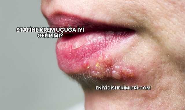 Stafine Krem Uçuğa İyi Gelir mi?