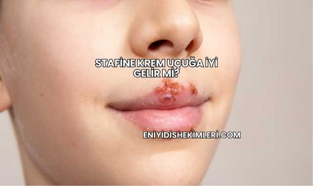 Stafine Krem Uçuğa İyi Gelir mi?
