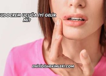 Sudocrem Uçuğa İyi Gelir mi?