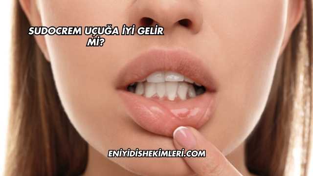 Sudocrem Uçuğa İyi Gelir mi?