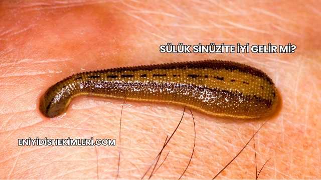 Sülük Sinüzite İyi Gelir mi?