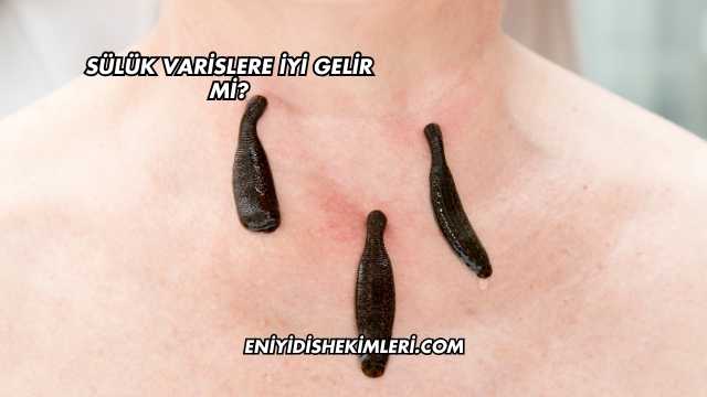 Sülük Varislere İyi Gelir mi?