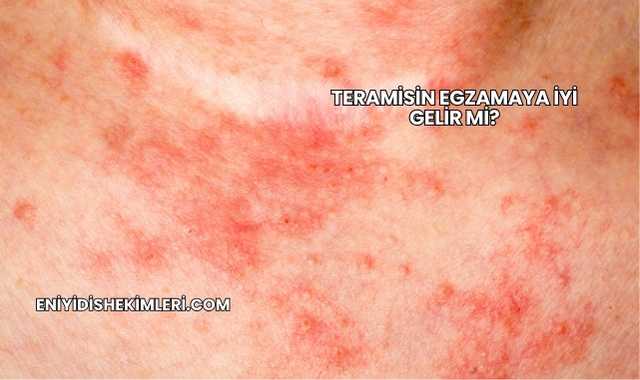Teramisin Egzamaya İyi Gelir mi?