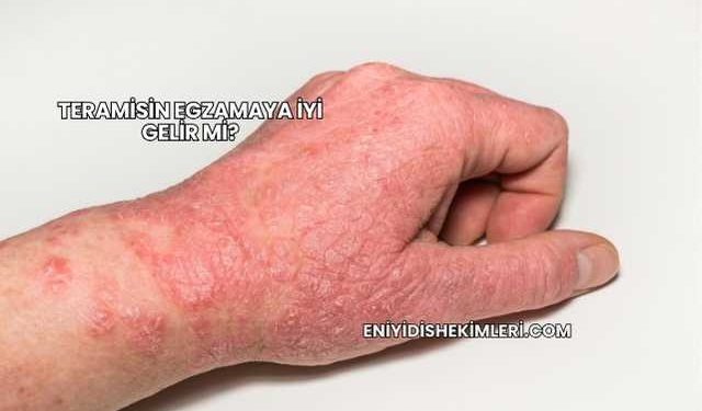 Teramisin Egzamaya İyi Gelir mi?