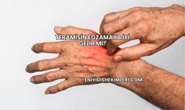 Teramisin Egzamaya İyi Gelir mi?