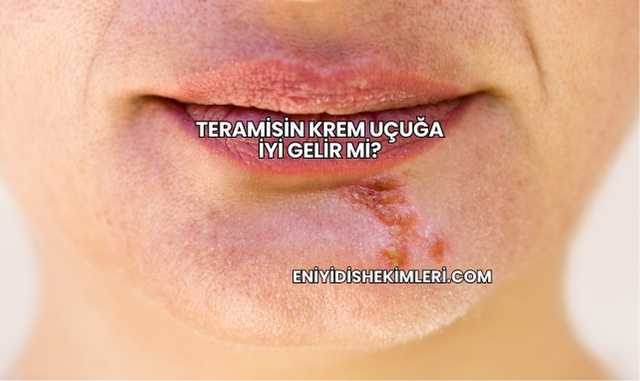 Teramisin Krem Uçuğa İyi Gelir mi?