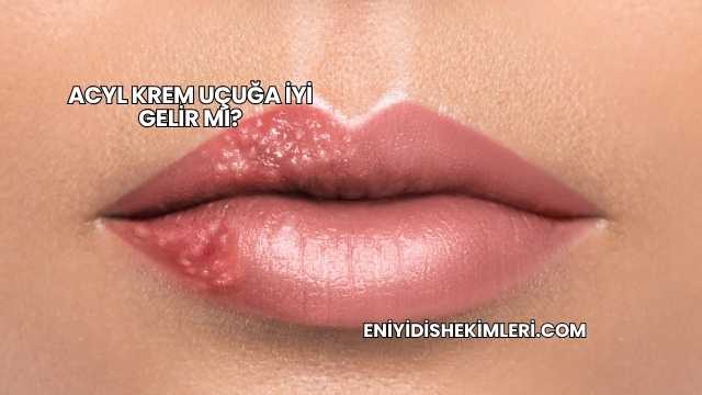 Acyl Krem Uçuğa İyi Gelir mi?