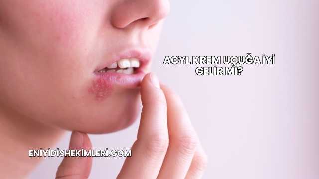 Acyl Krem Uçuğa İyi Gelir mi?