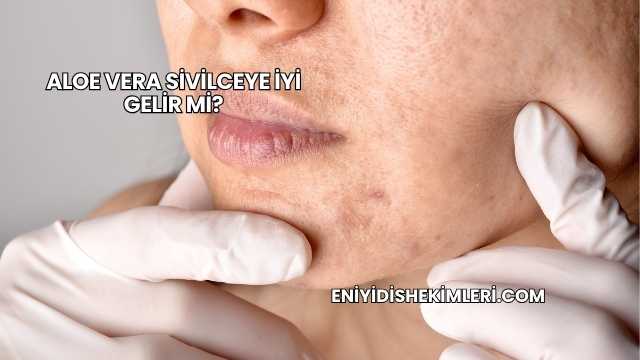 Aloe Vera Sivilceye İyi Gelir mi?