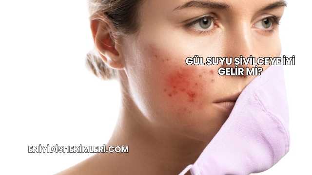 Aloe Vera Sivilceye İyi Gelir mi?