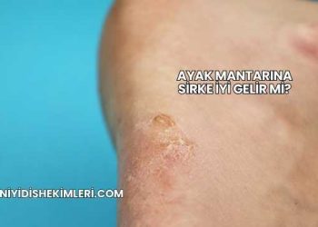 Ayak Mantarına Sirke İyi Gelir mi?