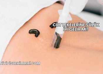 Cilt Lekelerine Sülük İyi Gelir mi?