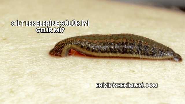 Cilt Lekelerine Sülük İyi Gelir mi?