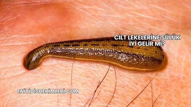 Cilt Lekelerine Sülük İyi Gelir mi?