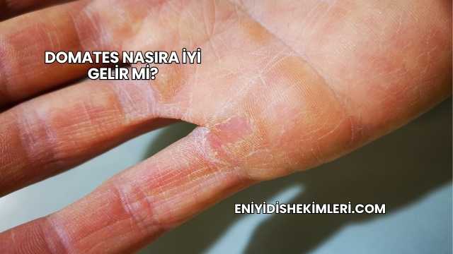 Domates Nasıra İyi Gelir mi?