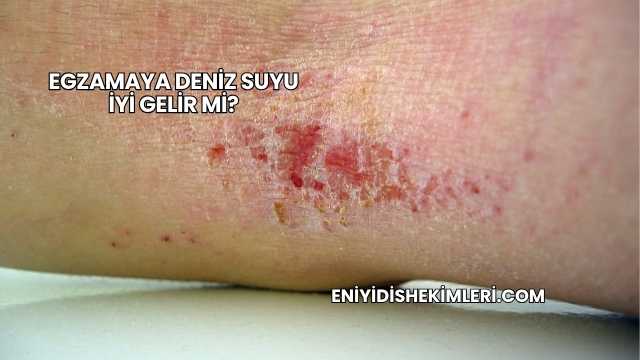 Egzamaya Deniz Suyu İyi Gelir mi?