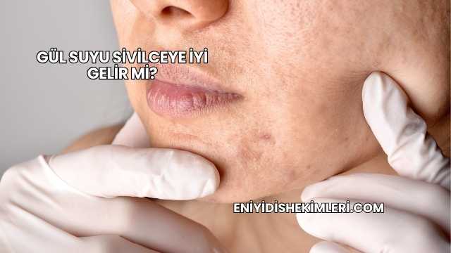 Gül Suyu Sivilceye İyi Gelir mi?