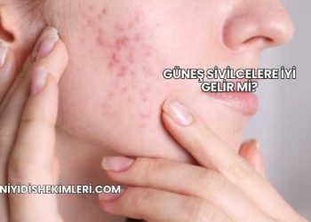 Güneş Sivilcelere İyi Gelir mi?