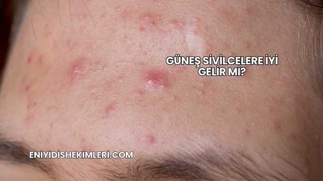 Güneş Sivilcelere İyi Gelir mi?
