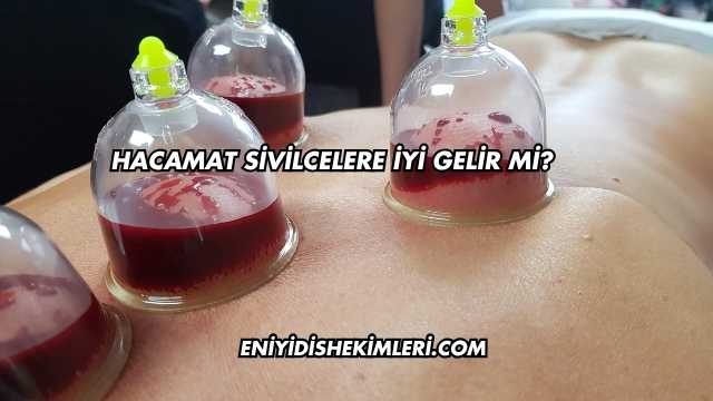 Hacamat Sivilcelere İyi Gelir mi?