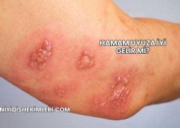 Hamam Uyuza İyi Gelir mi?