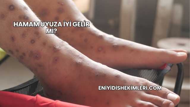 Hamam Uyuza İyi Gelir mi?